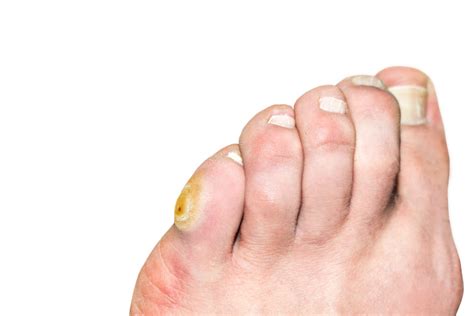 How To Get Rid Of Corns On The Foot