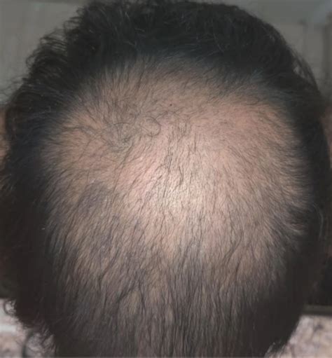 7 Months After Microneedling Minoxidil And Finasteride Wrassman M D