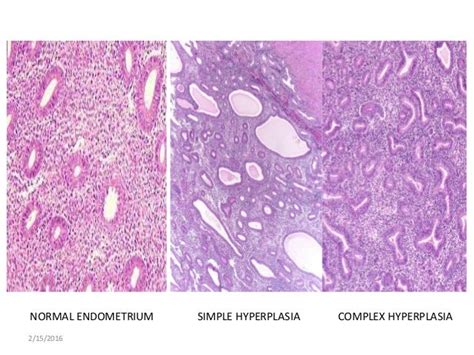 Endometrial Hyperplasia