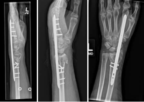 Dr. Sammy - Distal Radius Fracture