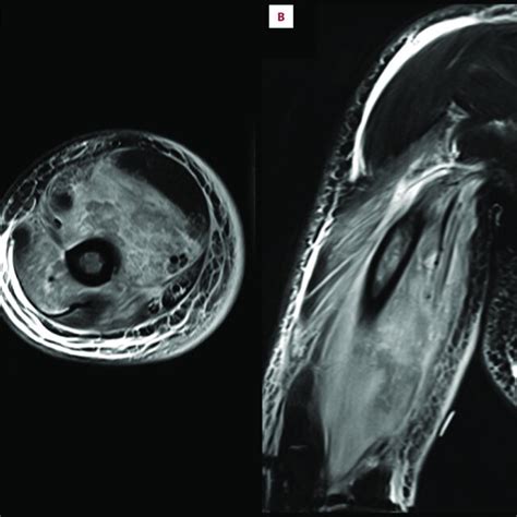 Fat Suppressed T2 Weighted Magnetic Resonance Imaging Showed Diffuse Download Scientific