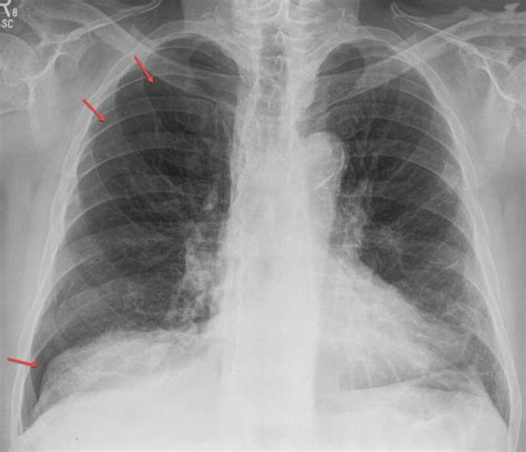 Pneumothorax Radiology For Beginners By Dr Samuel Kobba