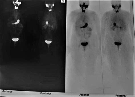 Iodine Whole Body Scan Was Performed Results Reported That No