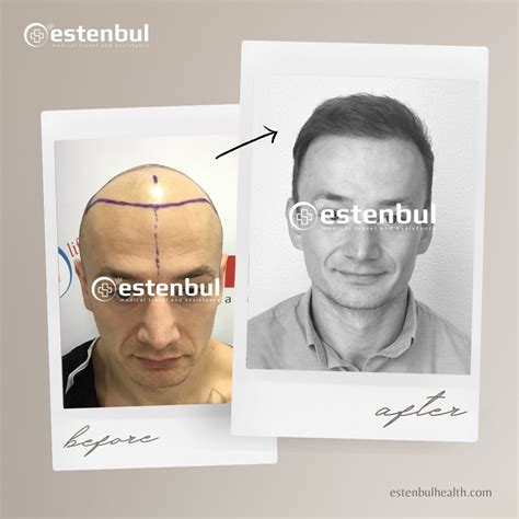 Hair Transplant Turkey Before And After Results Artofit