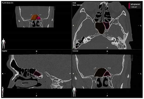 Volumetric Evaluation Of The Sphenoid Sinus Among Different Races In