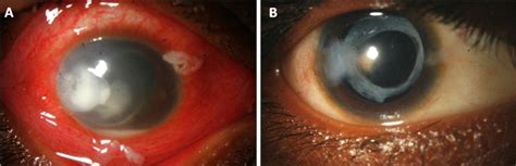 A External Photograph Right Eye Showing Corneal Infiltration At Site Download Scientific