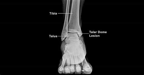 Talar Dome Injury Management For Foot East Coast Podiatry