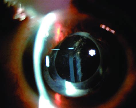 Od Postoperative Slit Lamp Photograph Showing Clear Intact And