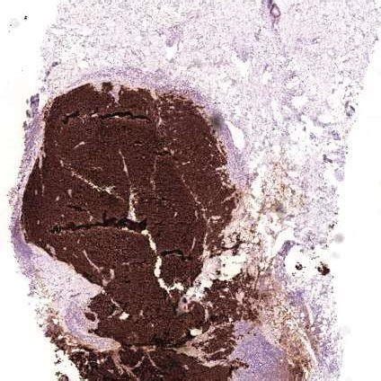 Cytokeratin Ck Staining Of Merkel Cell Carcinoma Mcc The Mcc