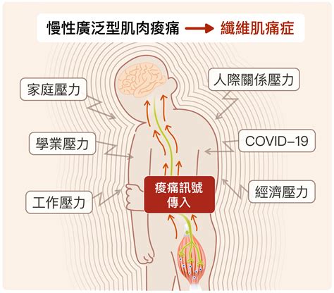 全身痠痛可能是壓力造成，還無藥可醫？揭開常見又神秘的疼痛病｜天下雜誌