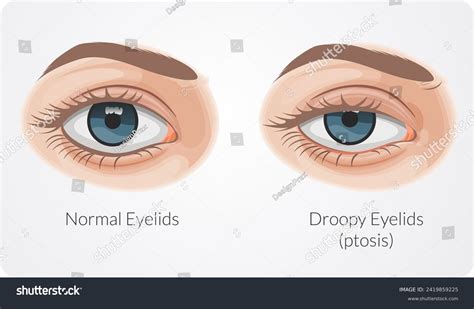 Ptosis Drooping Upper Eyelid Stock Royalty Free Stock Vector