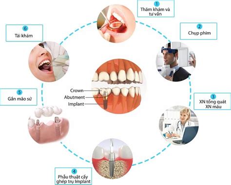 Hướng Dẫn Quy Trình Trồng Răng Implant Chuẩn Nhất Từ A đến Z