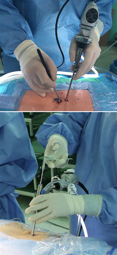 Figure 1 From Comparative Analysis Of Three Types Of Minimally Invasive