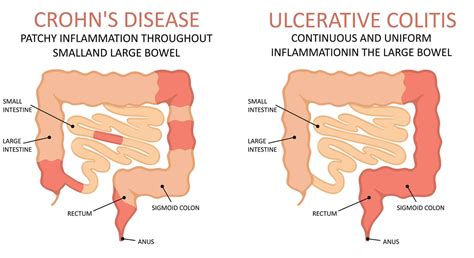 What Is Ulcerative Colitis Pain Resource