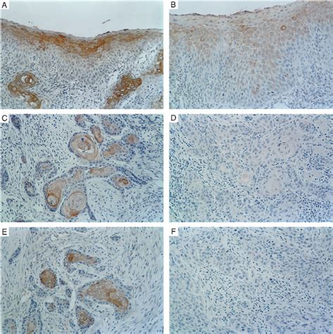 Immunohistochemical Staining Patterns Of Fhit In SCCs Of The Tongue A