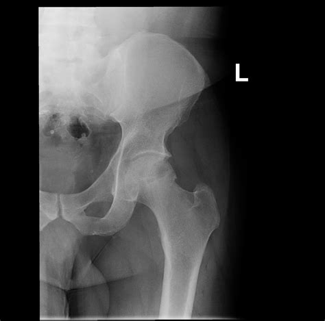 Avascular Necrosis Of The Hip Bilateral Image