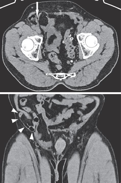 Figure 2 From Concomitant Medial And Interparietal Inguinal Hernias