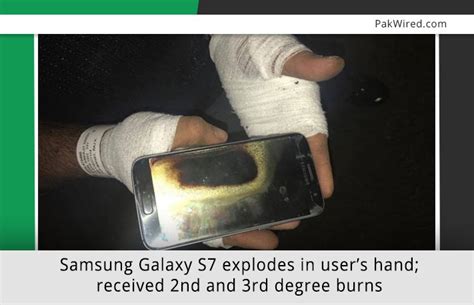 Samsung Galaxy S Explodes In Users Hand Received Nd And Rd Degree