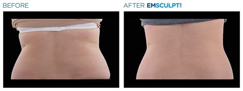 Emsculpt Neo Edge Austin Skin And Wellness