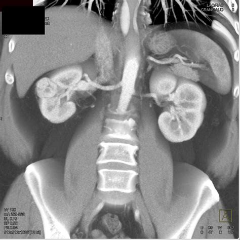 Multiphase Demonstration Of A Clear Cell Renal Cell Carcinoma Kidney