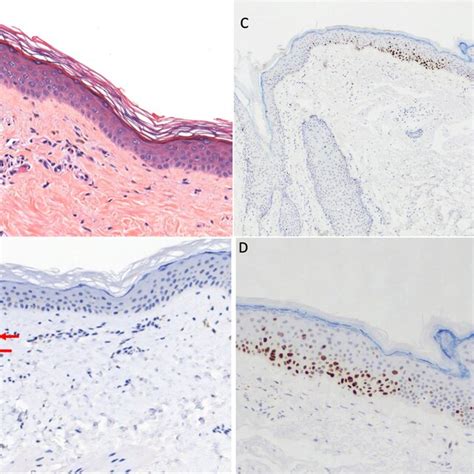 A Erythematous Vesicular Cutaneous Rash After 3 Months Of Therapy Download Scientific Diagram