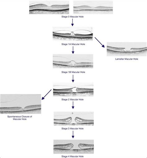 Macular Hole