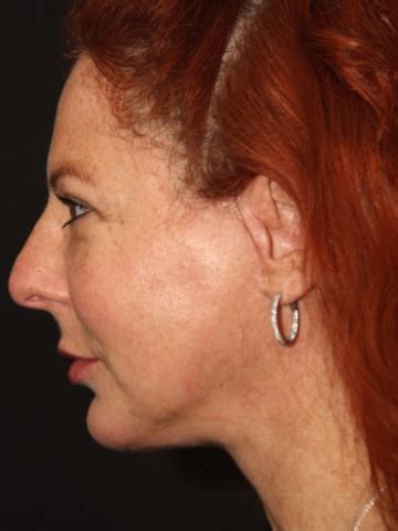 Patient Chin Implants C Solomon Facial Plastic