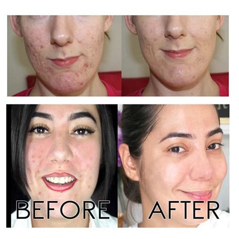 The Ordinary Peeling Solution Before And After A Comprehensive Review Must Read This Before