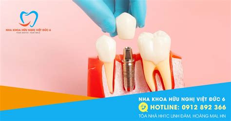 Điều kiện trồng răng Implant cần biết Nha Khoa Việt Đức 6