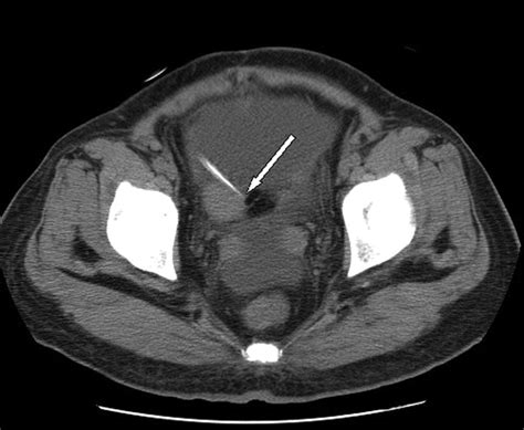 Hemoperitoneum Due To Tenckhoff Cathetercaused Luteal Cyst Rupture