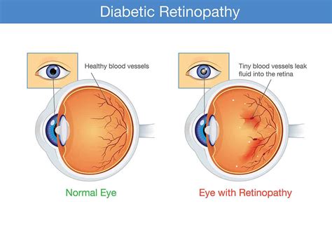 Diabetic Retinopathy Causes And Treatments Chelvin Sng Eye Center