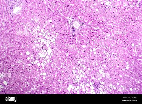 Fotomicrografía de esteatosis hepática que revela la acumulación de