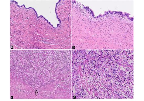 A Ovarian Cyst Wall Lined By Single Layer Of Cuboidal To Ciliated