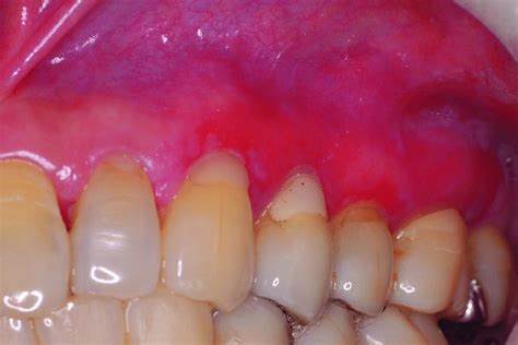 Erosive Lichen Planus Gingiva