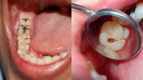 Cavity In Between Teeth Causes Symptoms And Treatments