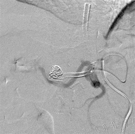 Hepatic Artery Pseudoaneurysm Embolization Image