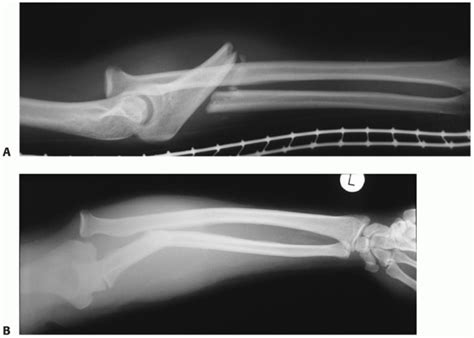 Radial And Ulnar Shaft Fractures Teachme Orthopedics