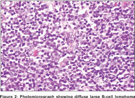 Histopathology Of Head And Neck Lymphomas In Ibadan Semantic Scholar