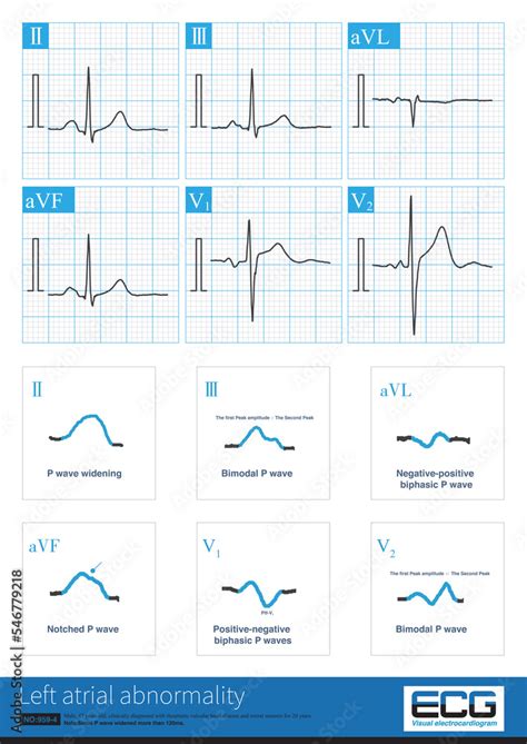 The ECG changes of left atrium abnormality include widening of P wave ...