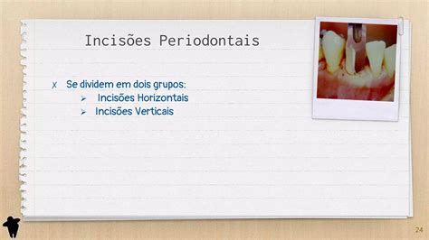 Resumo De Periodontia Classificação Dos Retalhos Periodontais Parte