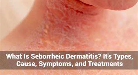 Qu Es La Dermatitis Seborreica Sus Tipos Causas S Ntomas Y