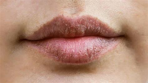 ¿por Qué Se Resecan Los Labios Mejor Con Salud