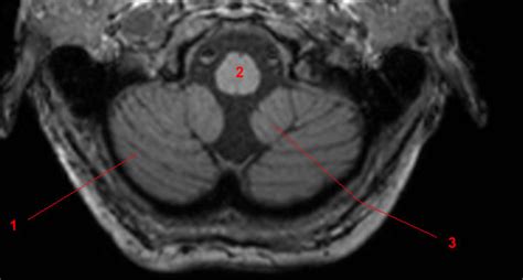 Cerebellum W Radiology