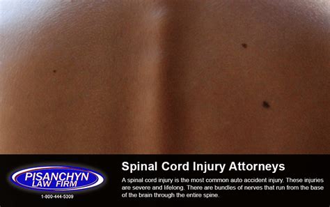 Spinal Cord Injury Attorneys Michael Pisanchyn Catastrophic Injuries