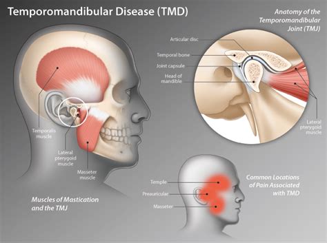 Tmj Syndrome Ericvisser