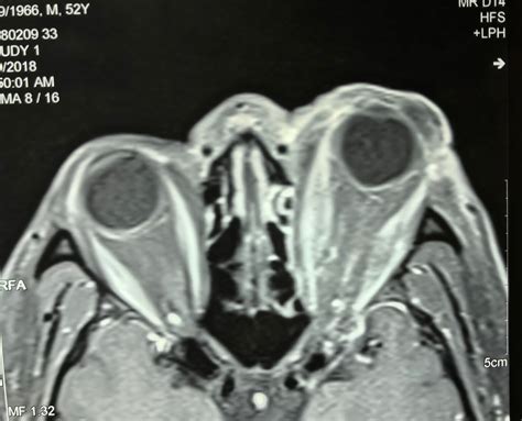 Vietnamese Medic Ultrasound Case 477 Left Exopthalmic Eye Dr Phan