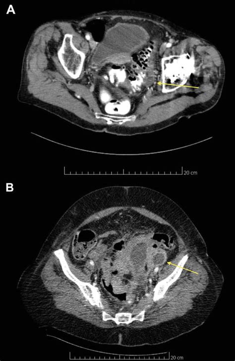 Colonoscopy After Diverticulitis Intechopen