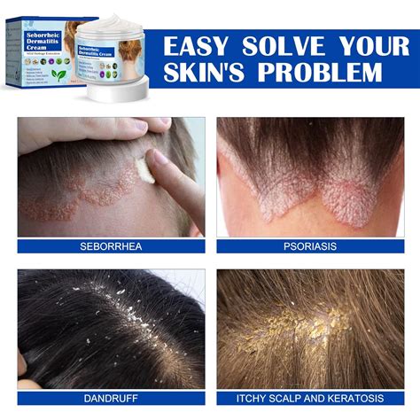 Buy Psoriasis Cream Seborrheic Dermatitis Cream Scalp Treatment For