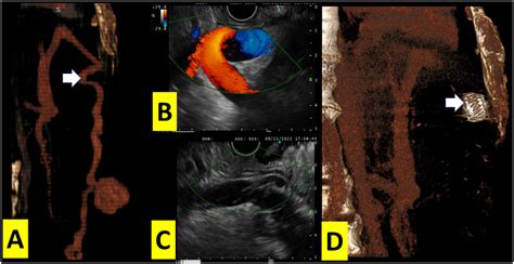 Endoscopic Ultrasound Guided Transgastric Shunt Occlusion For