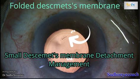 Descemets Membrane Detachment How To Prevent And Minimise Its Impact